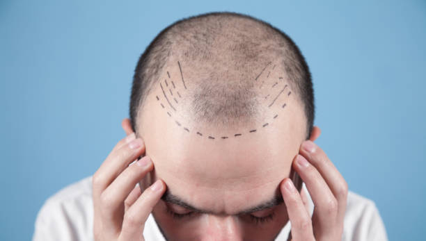 Hair Restoration Excellence: Leading Hair Transplant Clinics in Riyadh