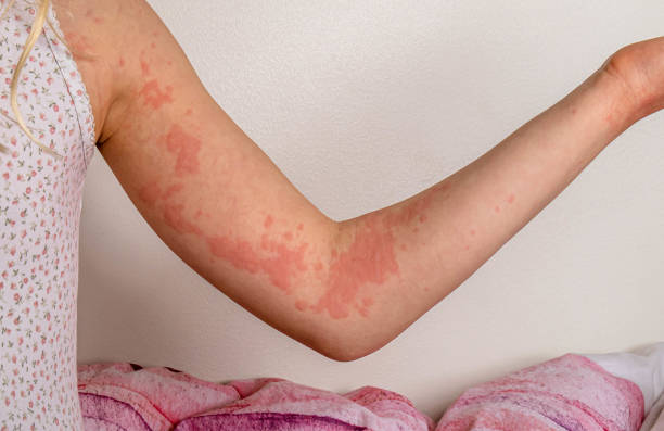 Discover all there is to know about fungal infections.